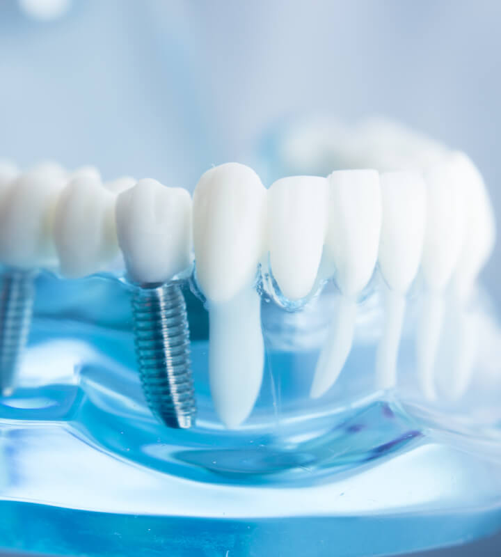 Soluții avansate de Implant Dentar la clinica Ivertumm