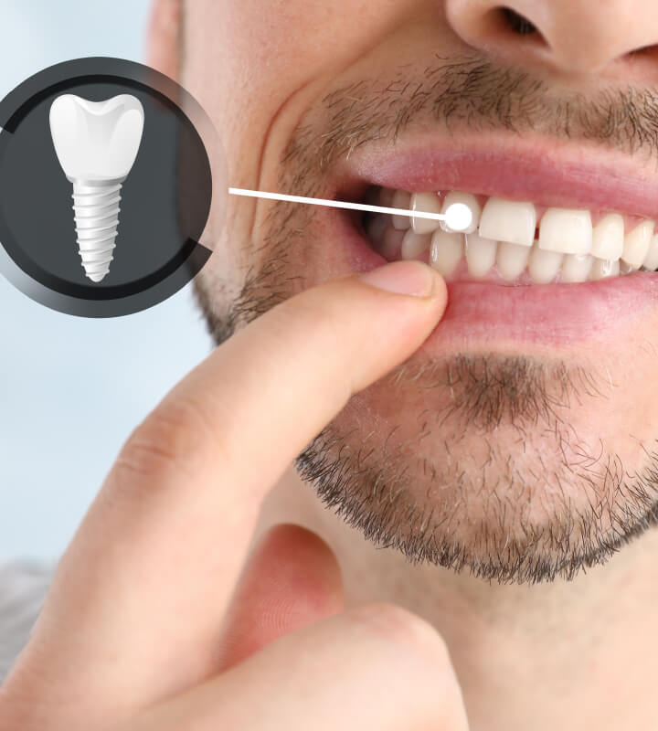 Etapele inserării unui Implant Dentar