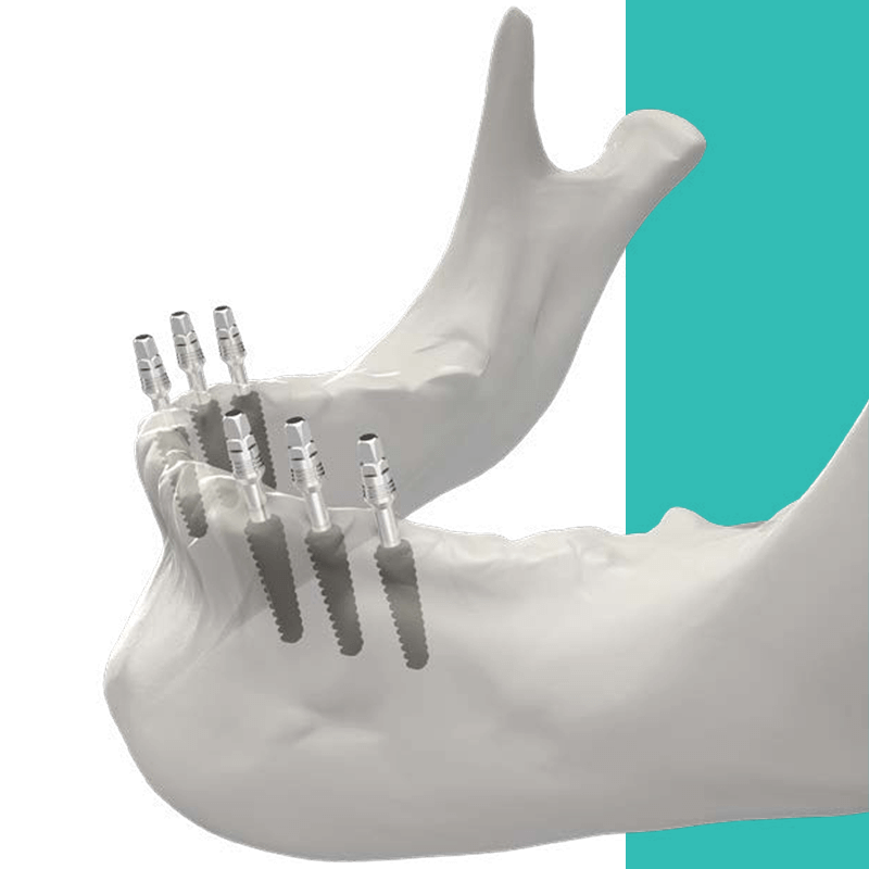 Monoimplant One-Piece